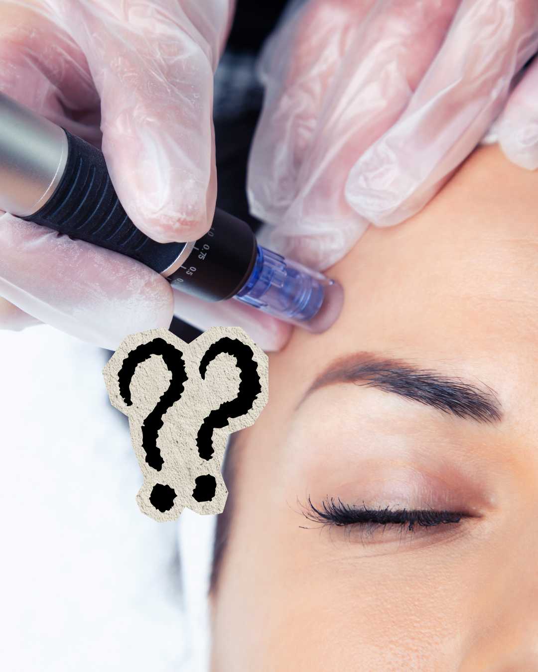 Microneedling Behandlung Natural Studios Weinböhla